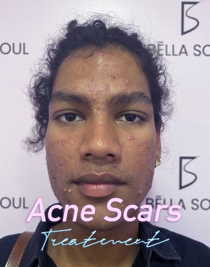 Acne Scare Treatment before and after at bella soul clinic delhi Bella Soul Clinic