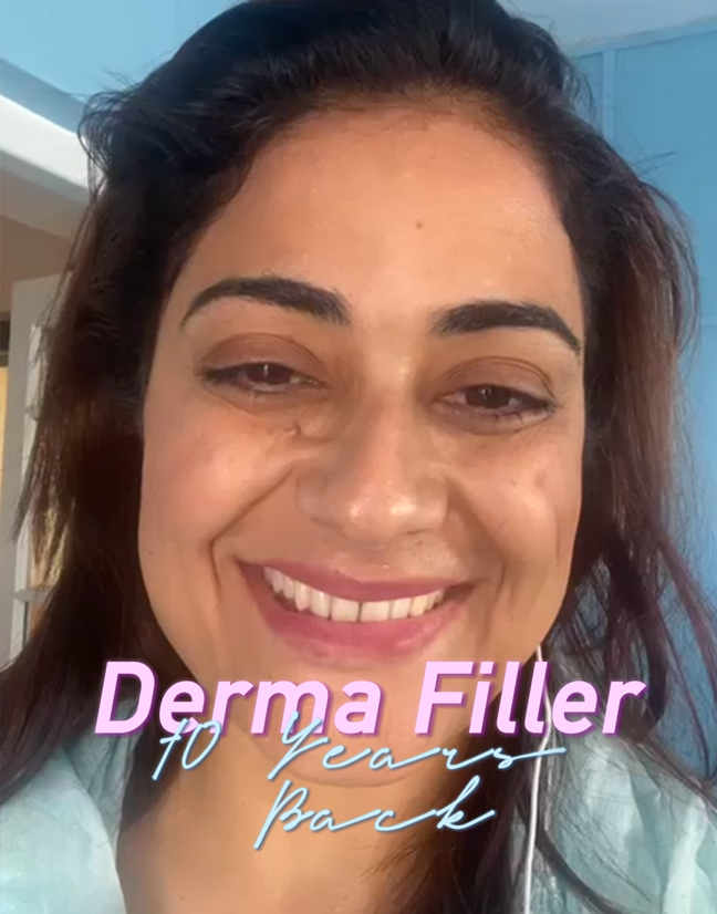 Dermal filler — before and after at Bella Soul Clinic