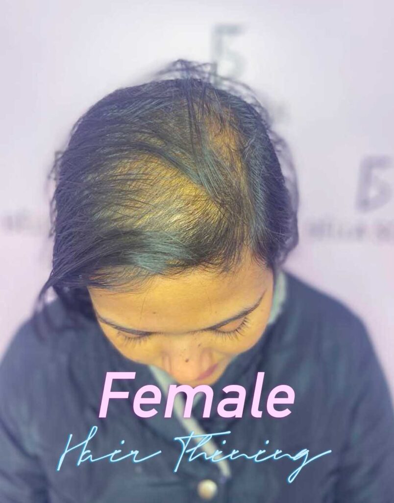 Female Hair Thining Treatment at Bella Soul Clinic Bella Soul Clinic