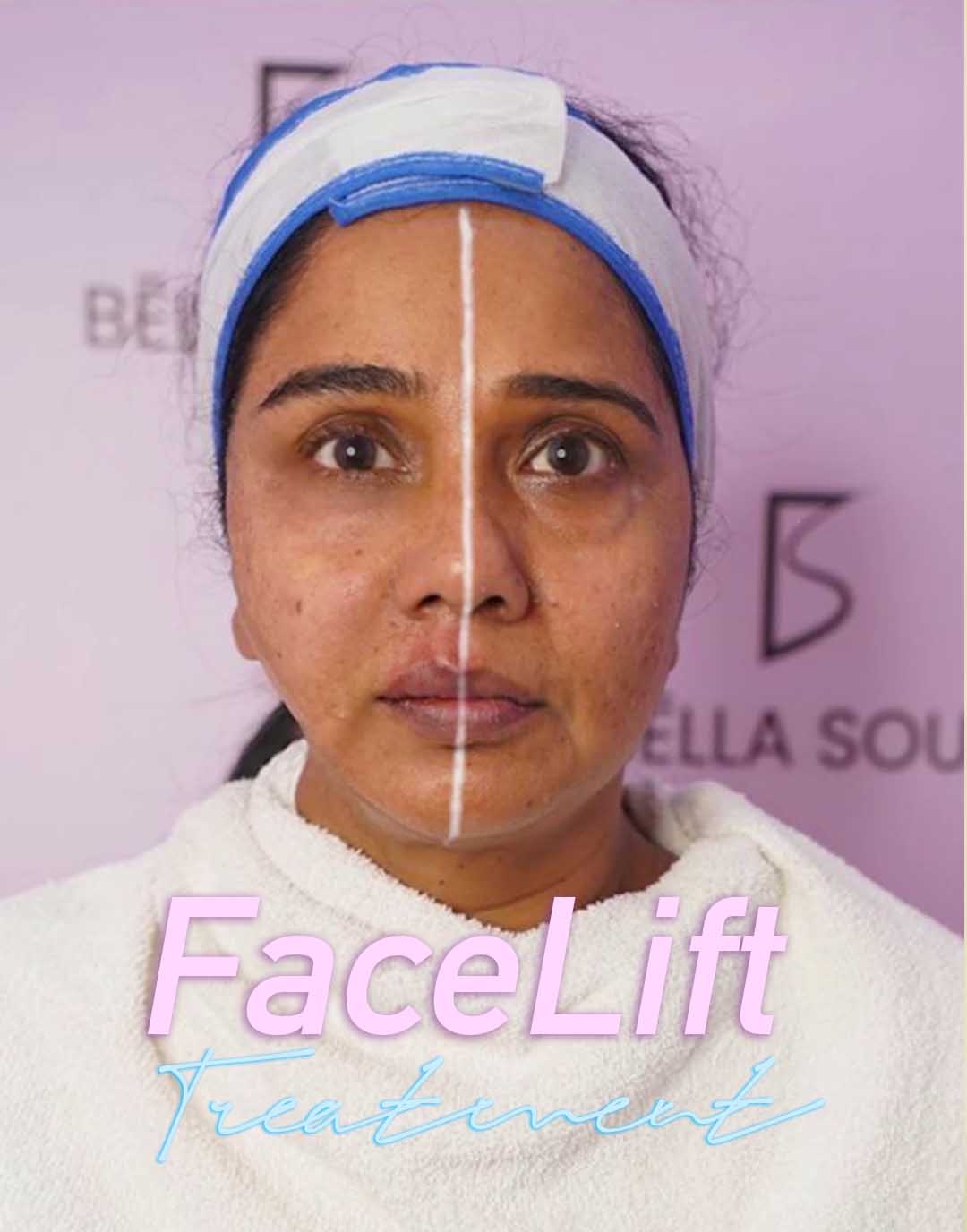Facelift