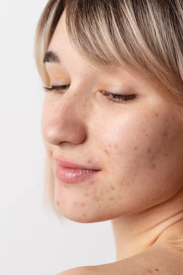 Acne Scar Treatment Bella Soul Clinic
