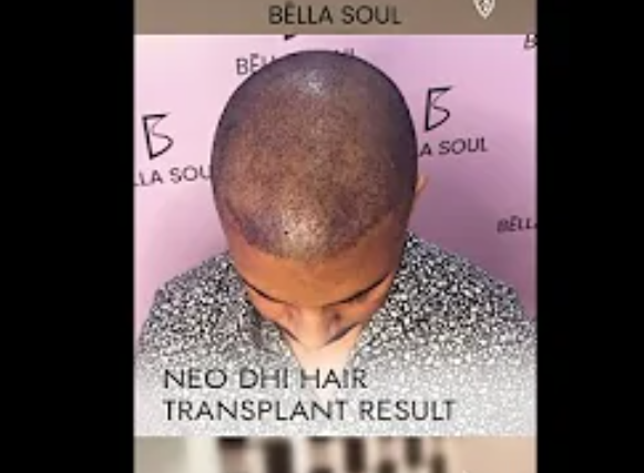 NEO DHI Hair Transplant