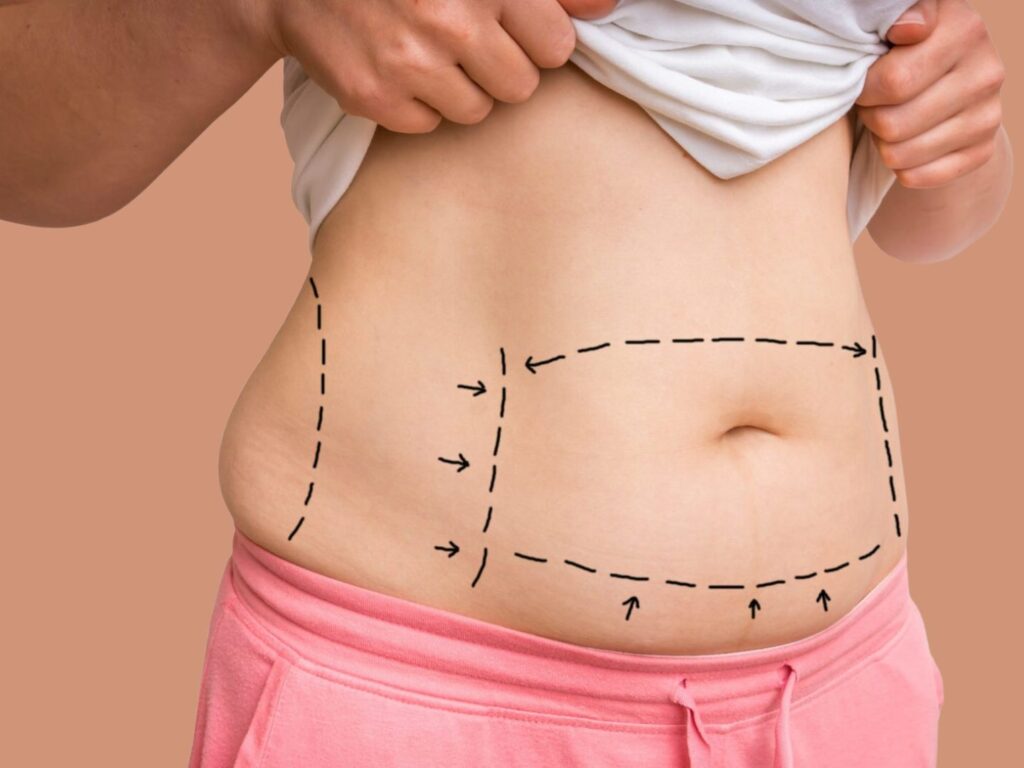 What is Tummy Tuck